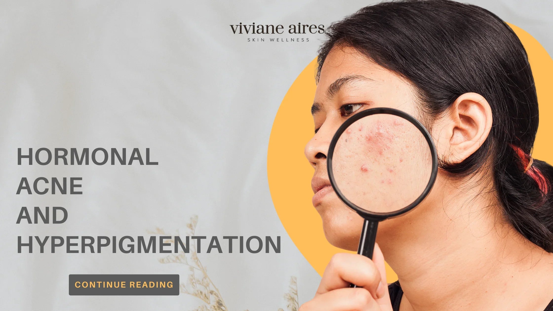 Hormonal Acne and Hyperpigmentation by Viviane Aires